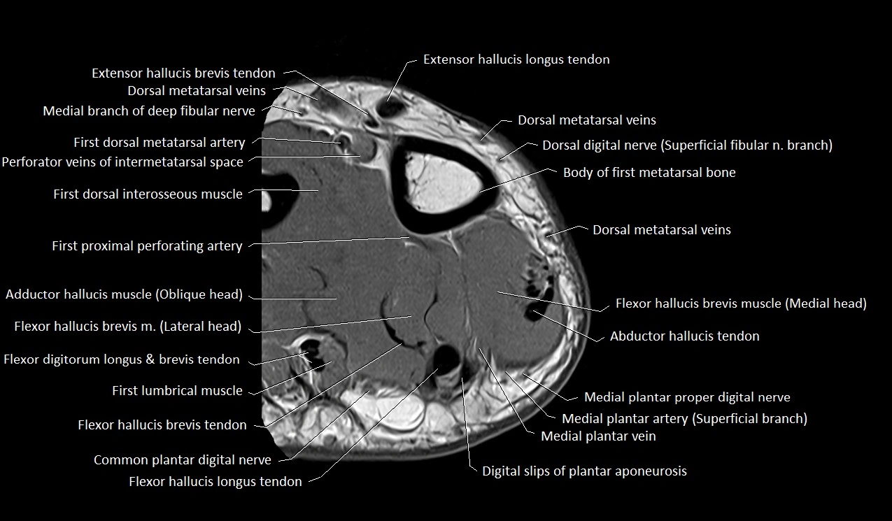 Great toe (hallux) axial microanatomy 3T MRI image 34.webp